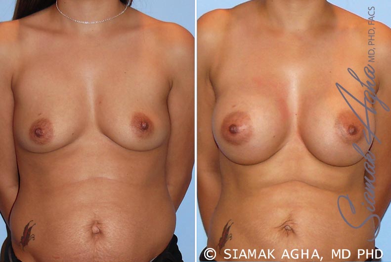 orange county breast augmentation patient 26 front Newport Beach, CA