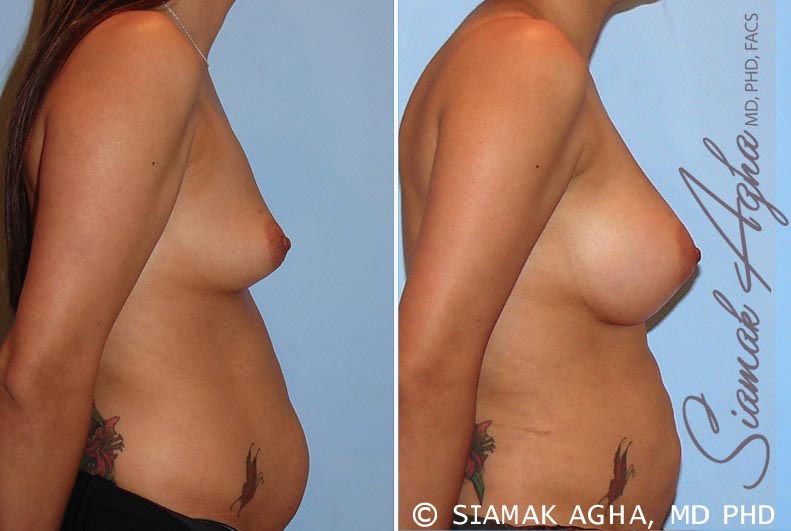 orange county breast augmentation patient 26 right Newport Beach, CA