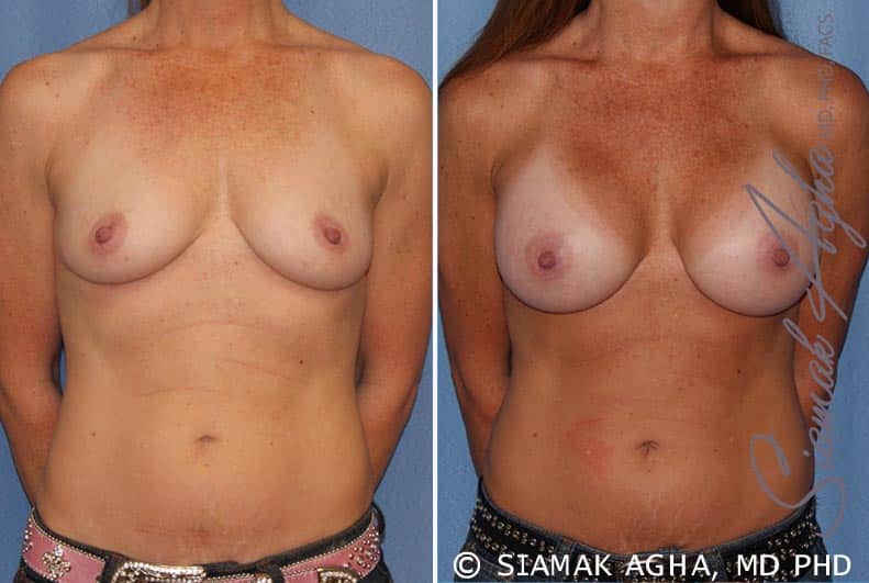 orange county breast augmentation patient 27 front Newport Beach, CA