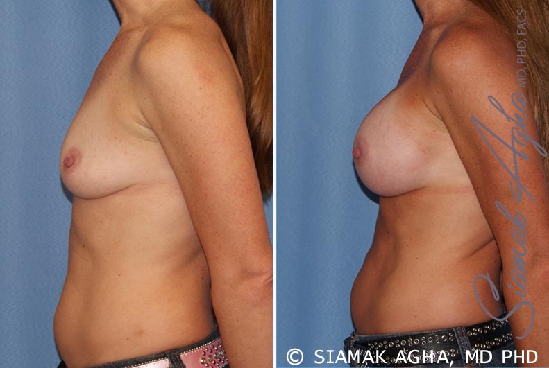 orange county breast augmentation patient 27 left Newport Beach, CA