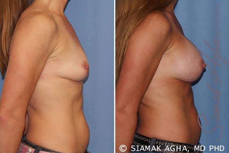 orange county breast augmentation patient 27 right Newport Beach, CA