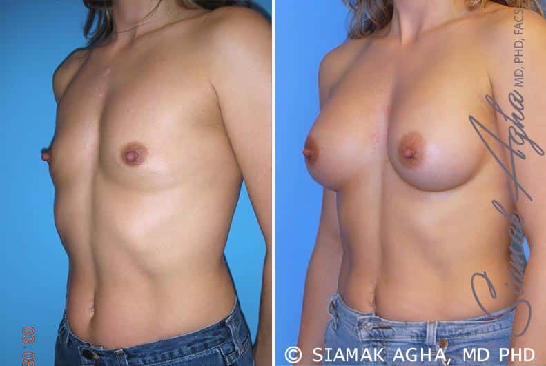 orange county breast augmentation patient 28 front left Newport Beach, CA