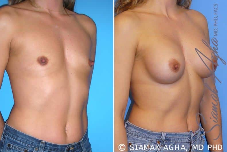 orange county breast augmentation patient 28 front right Newport Beach, CA