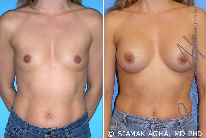 orange county breast augmentation patient 28 front Newport Beach, CA