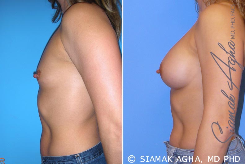 orange county breast augmentation patient 28 left Newport Beach, CA