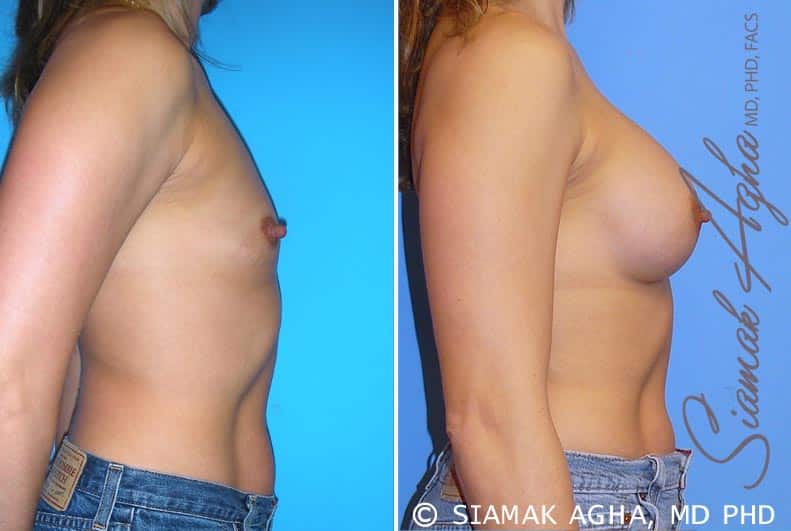 orange county breast augmentation patient 28 right Newport Beach, CA
