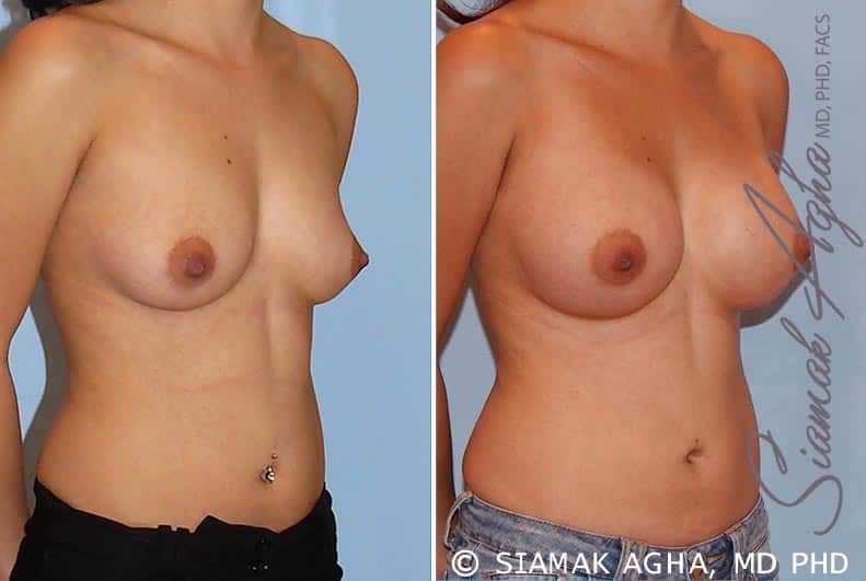 orange county breast augmentation patient 29 front right Newport Beach, CA