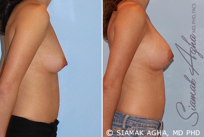 Breast Augmentation Patient 29