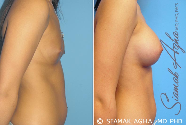 orange county breast augmentation patient 3 right Newport Beach, CA