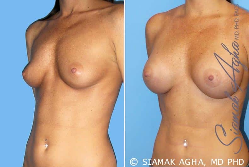 orange county breast augmentation patient 30 front left Newport Beach, CA