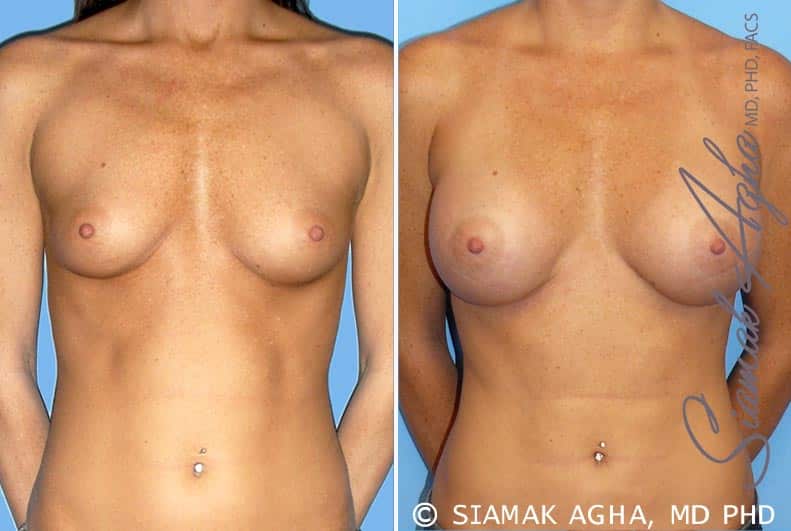 Breast Augmentation Patient 30