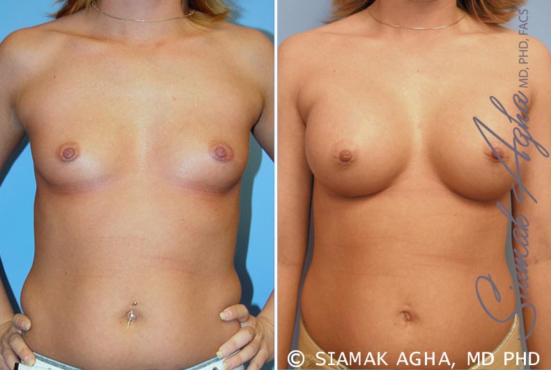 Breast Augmentation Patient 31