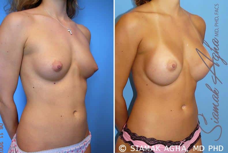 orange county breast augmentation patient 32 front right Newport Beach, CA