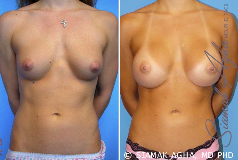 orange county breast augmentation patient 32 front Newport Beach, CA