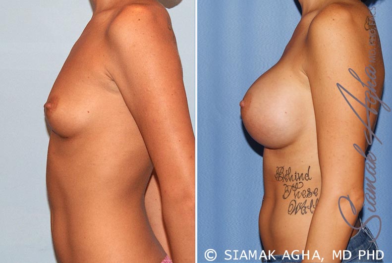 orange county breast augmentation patient 33 left Newport Beach, CA
