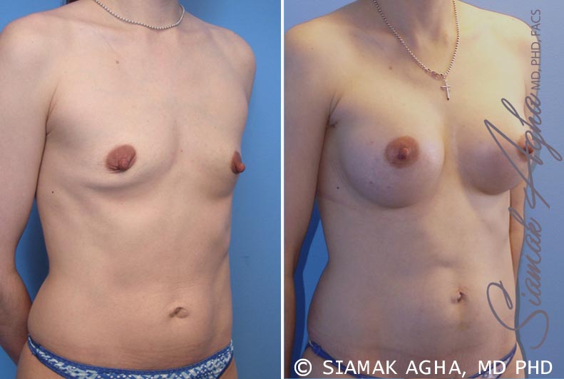 Breast Augmentation Patient 34