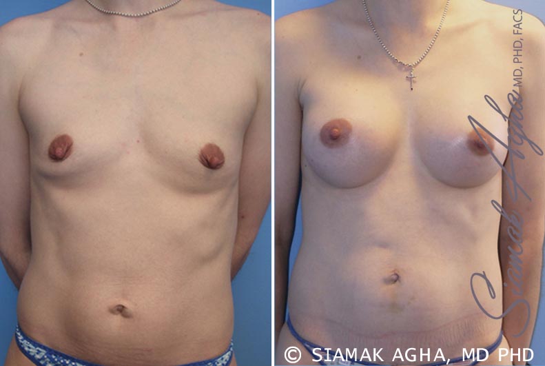 Breast Augmentation Patient 34