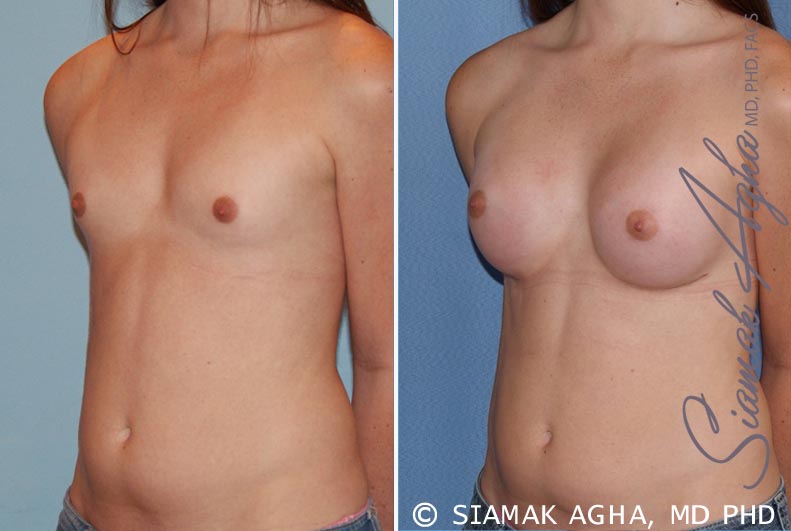 orange county breast augmentation patient 35 front left Newport Beach, CA