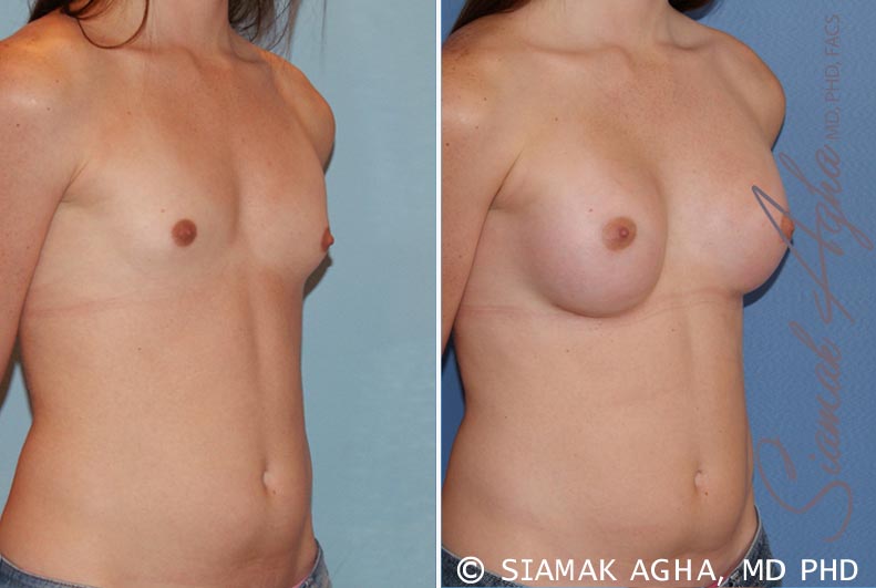 orange county breast augmentation patient 35 front right Newport Beach, CA