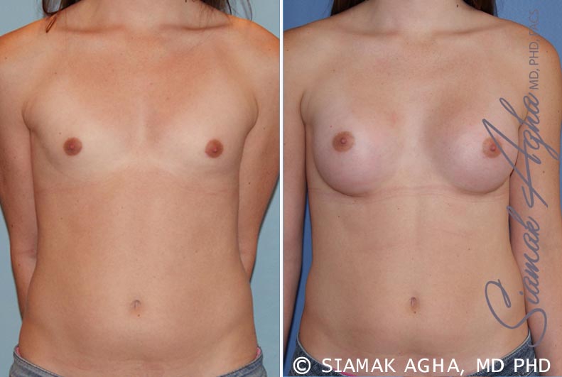 orange county breast augmentation patient 35 front Newport Beach, CA