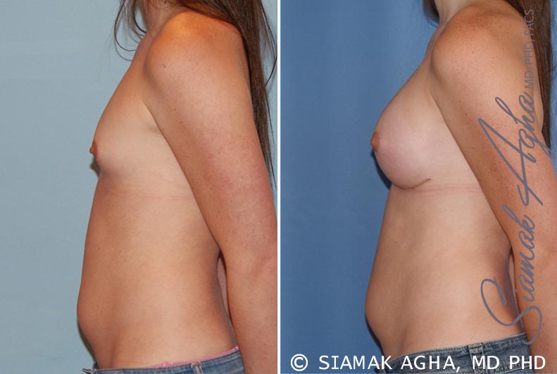 Breast Augmentation Patient 35