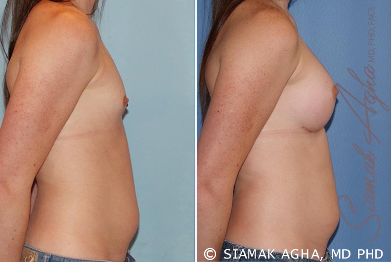 orange county breast augmentation patient 35 right Newport Beach, CA