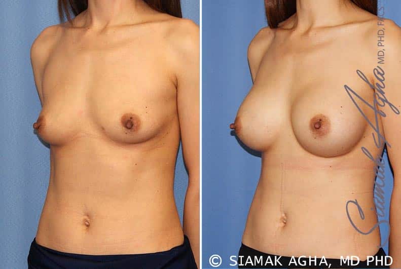 Breast Augmentation Patient 36