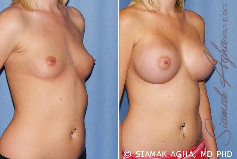 orange county breast augmentation patient 37 front right Newport Beach, CA