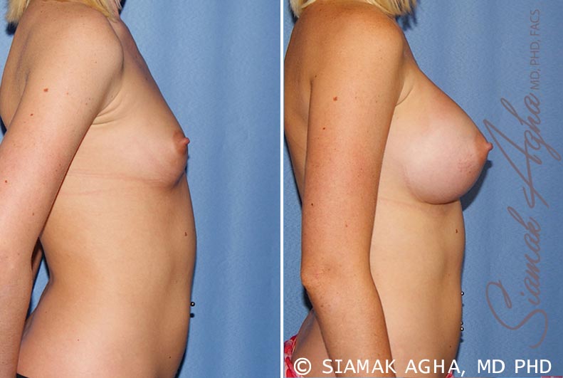 orange county breast augmentation patient 37 right Newport Beach, CA