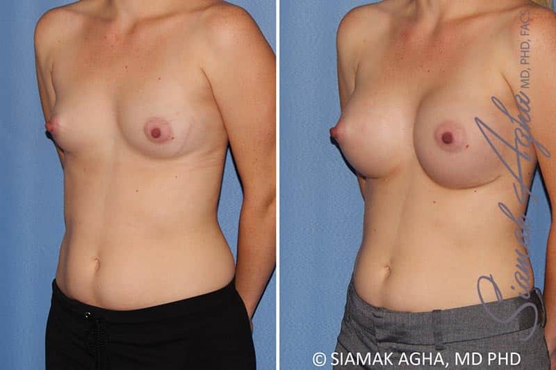 Breast Augmentation Patient 38
