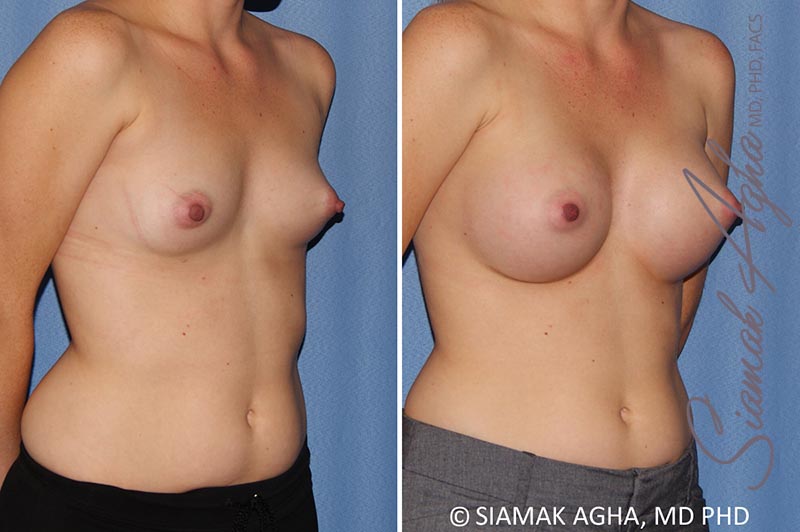 orange county breast augmentation patient 38 front right Newport Beach, CA