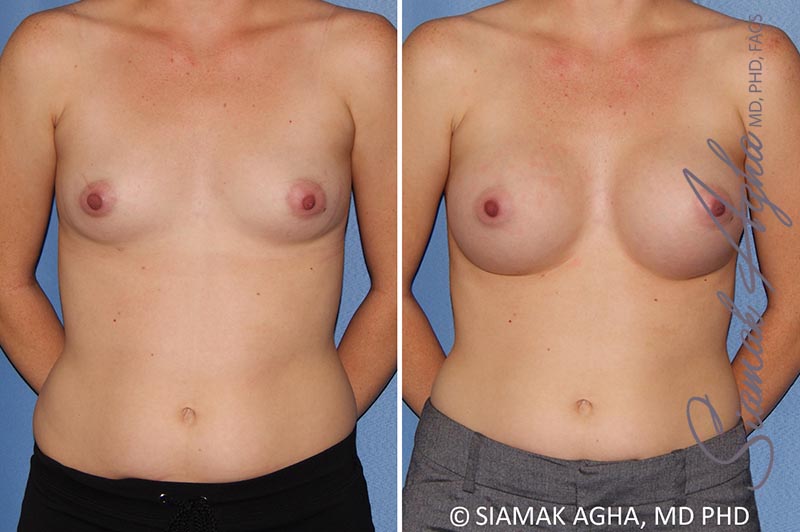 Breast Augmentation Patient 38