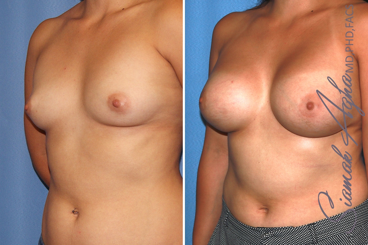 orange county breast augmentation patient 39 front left Newport Beach, CA