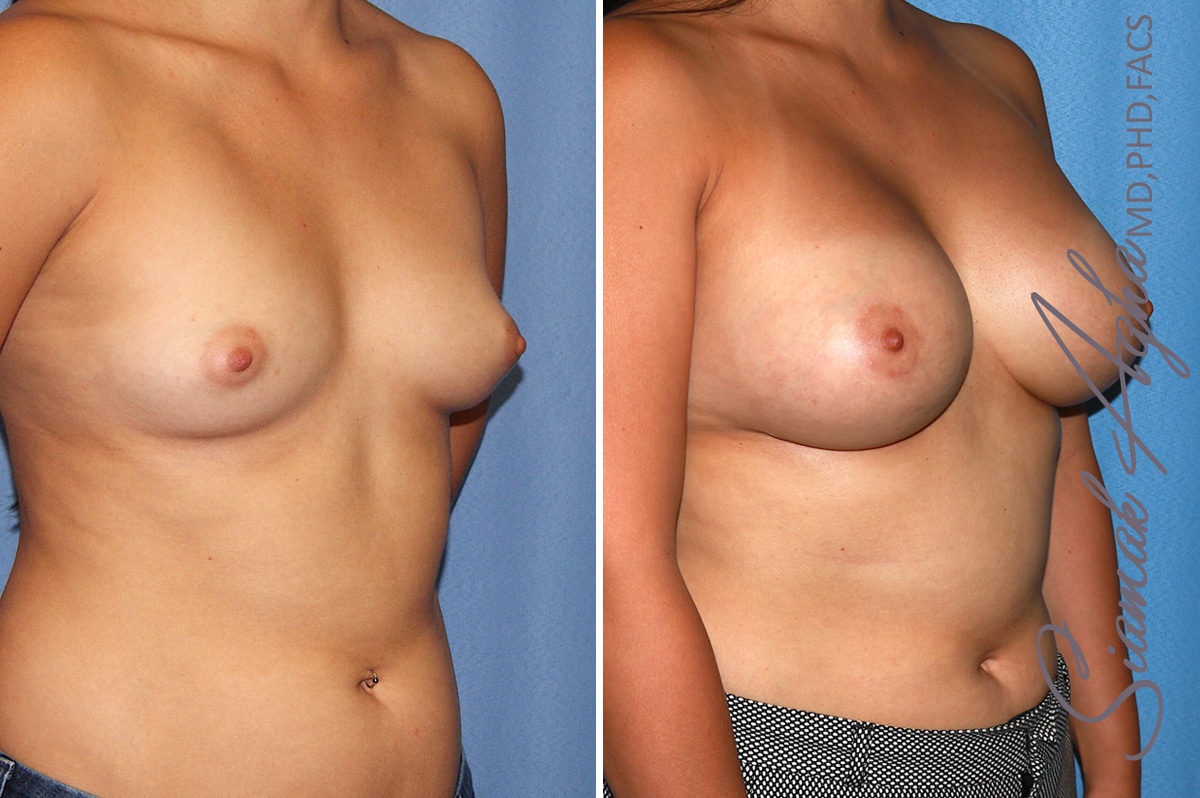 orange county breast augmentation patient 39 front right Newport Beach, CA