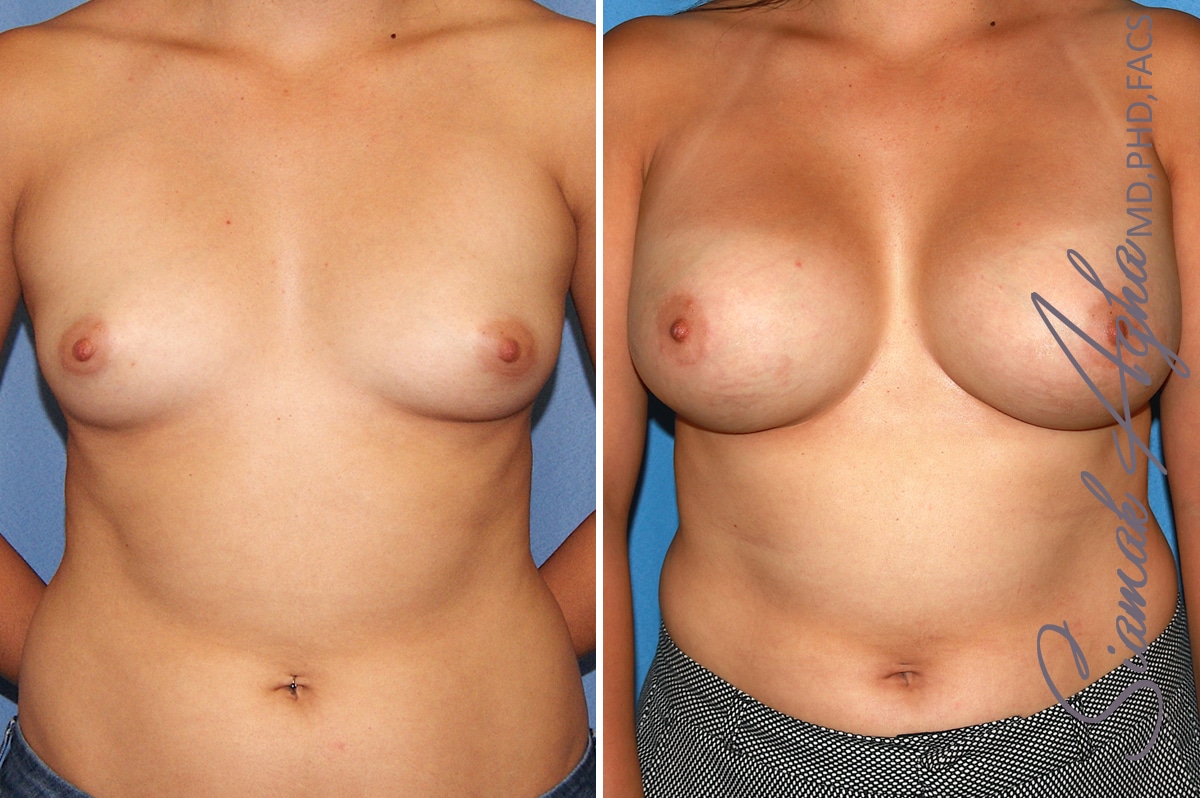 orange county breast augmentation patient 39 front Newport Beach, CA