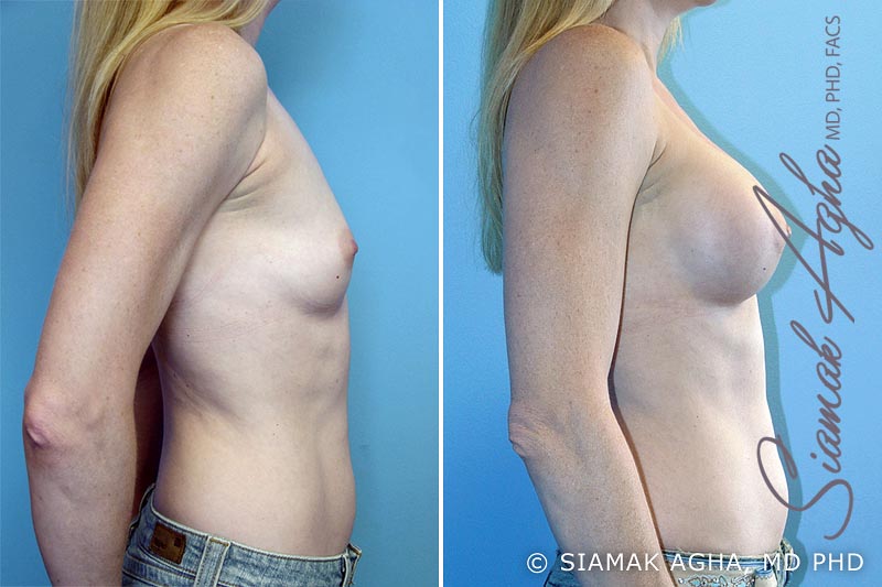 Breast Augmentation Patient 4