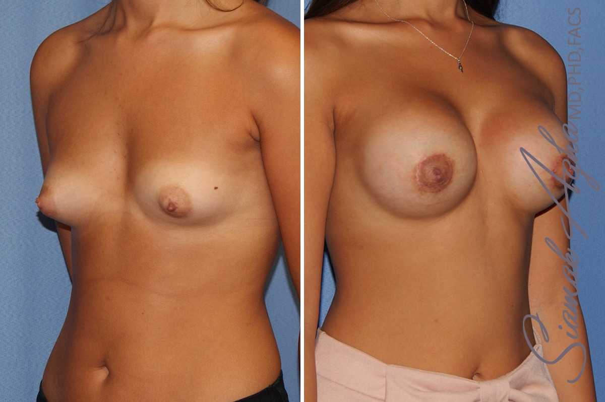 orange county breast augmentation patient 40 front right Newport Beach, CA