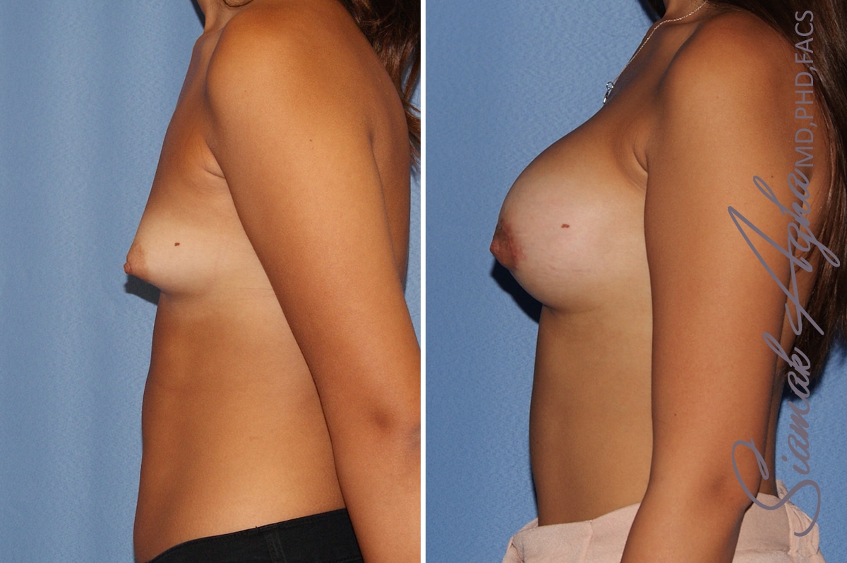 Breast Augmentation Patient 40