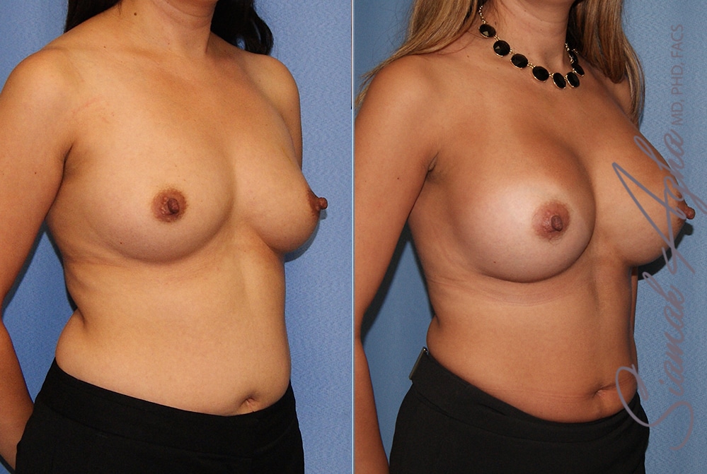 Breast Augmentation Patient 41