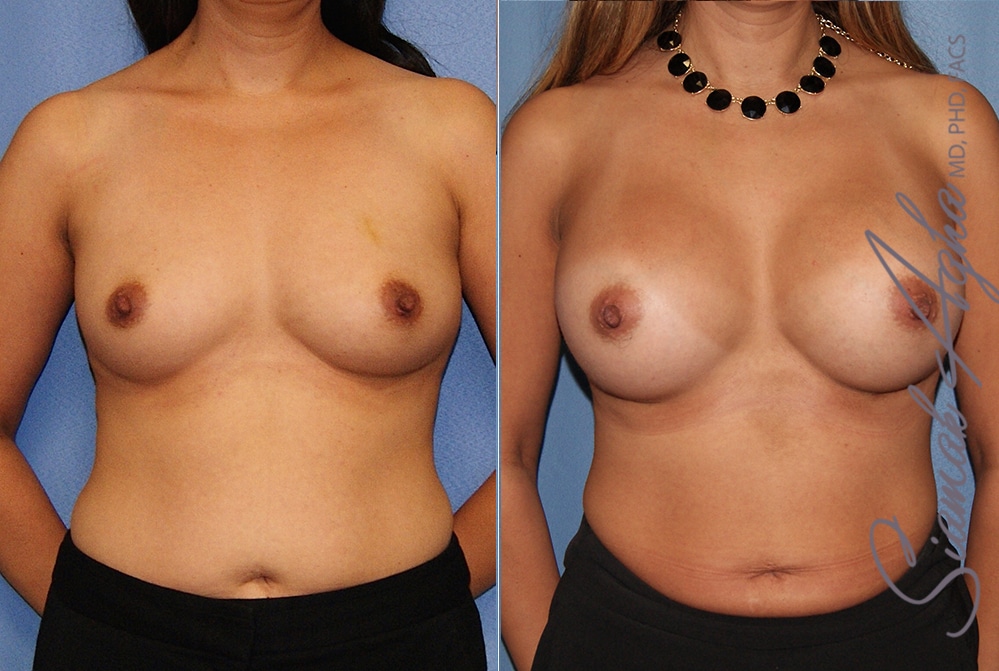 Breast Augmentation Patient 41