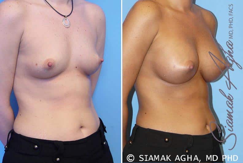 orange county breast augmentation patient 5 front right Newport Beach, CA