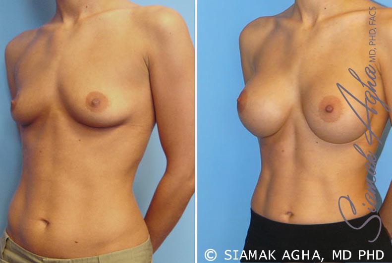 orange county breast augmentation patient 7 front left Newport Beach, CA
