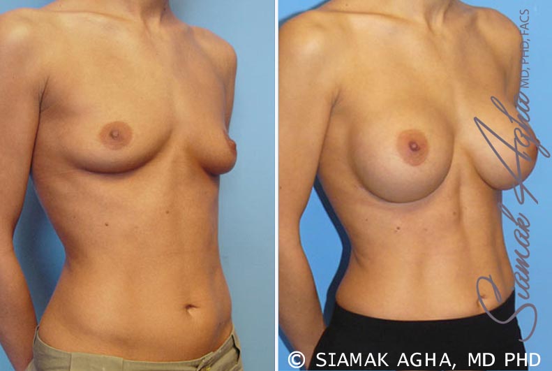 orange county breast augmentation patient 7 front right Newport Beach, CA