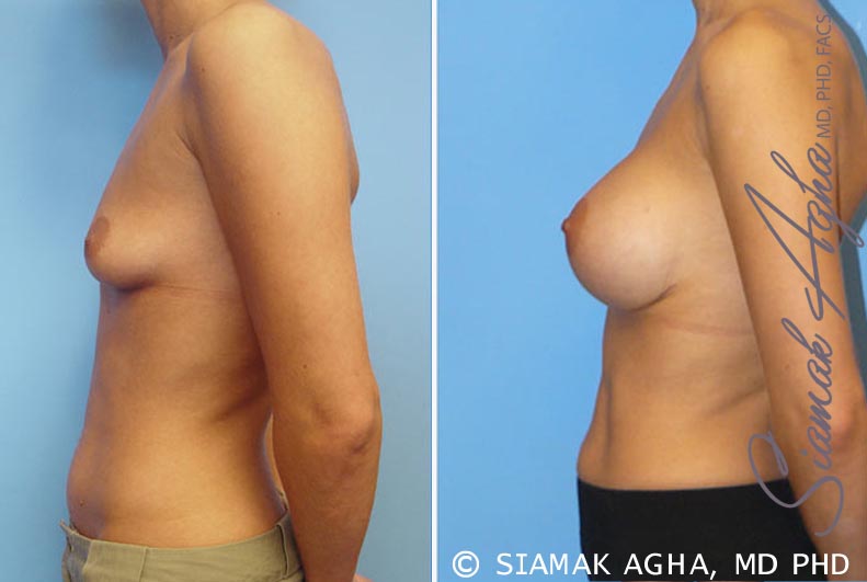 Breast Augmentation Patient 7