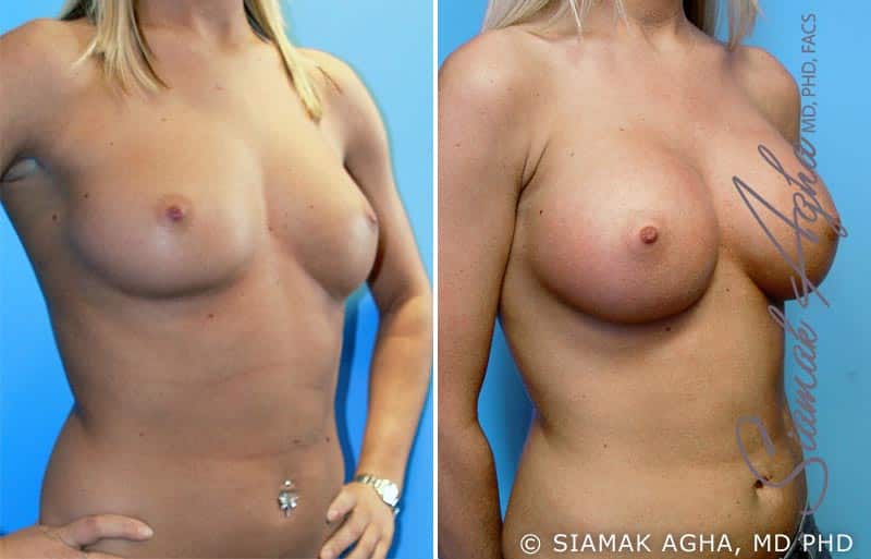 orange county breast augmentation patient 8 front right Newport Beach, CA