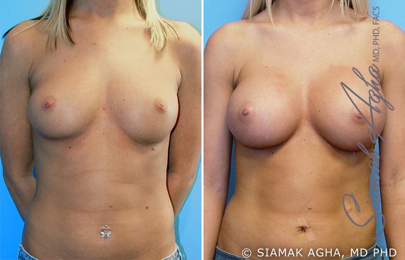 orange county breast augmentation patient 8 front Newport Beach, CA