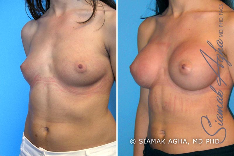 Breast Augmentation Patient 9