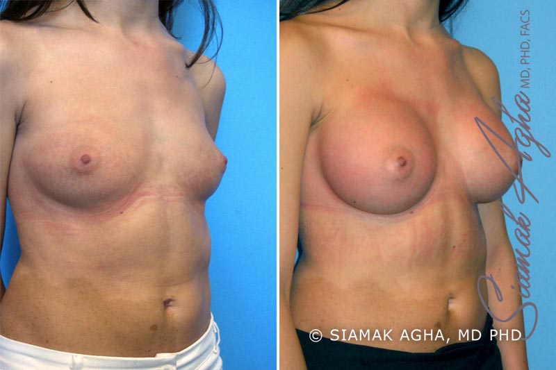 orange county breast augmentation patient 9 front right Newport Beach, CA