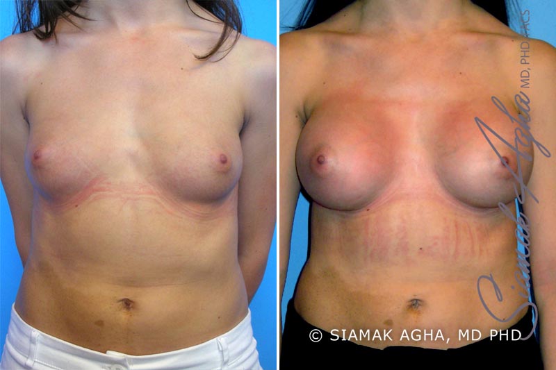 orange county breast augmentation patient 9 front Newport Beach, CA