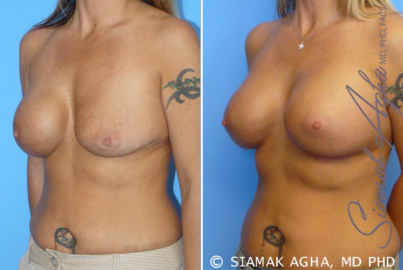 orange county breast augmentation revision patient 1 front left Newport Beach, CA